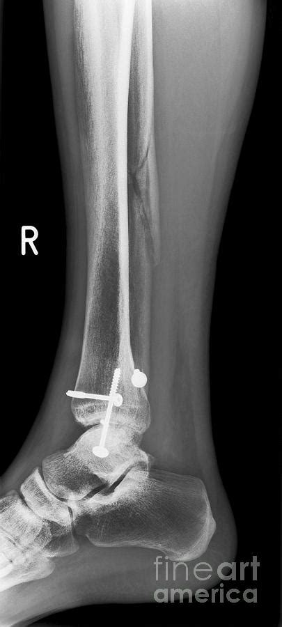 Pinned Broken Ankle, X-ray Photograph by Science Photo Library