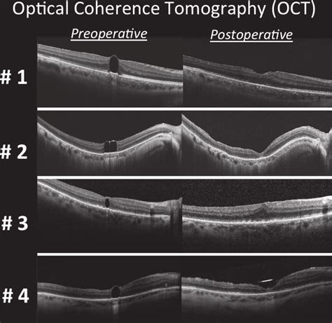 Preoperative And Postoperative Optical Coherence Tomography Oct