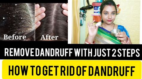 Dandruff Treatment At Home Remedies In Hindi How To Get Rid Of Dandruff Tips And Tricks Of