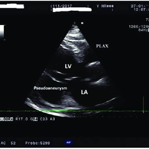 Parasternal Long Axis Plax View Showing A Pseudoaneurysm As A