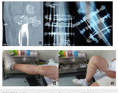 Table 1 From Treatment Of Schatzker Type II VI Tibial Plateau Fractures