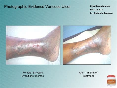 Varicose Ulcer Evidence - Part II - Circulat