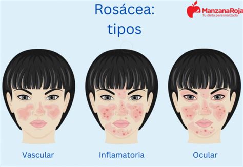 Rosácea Conoce Sus Causas Factores De Riesgo Y Tratamientos Efectivos