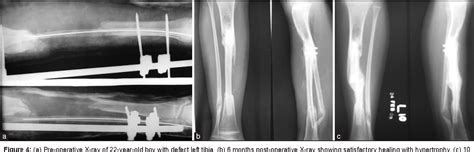 Figure From Reconstruction Of Post Traumatic Long Bone Defect With