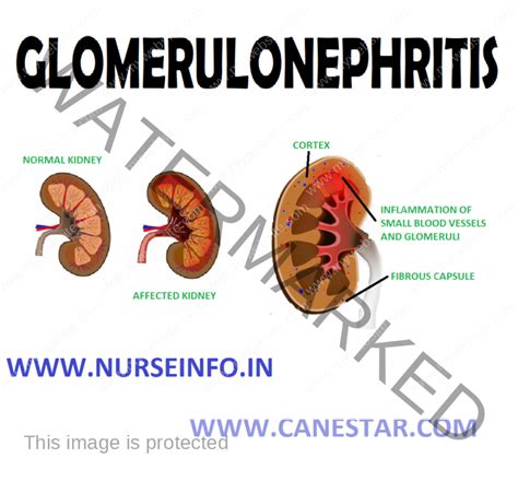 Glomerulonephritis Nurse Info