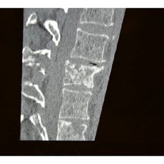 Case 1computed Tomography Of Thoracolumbar Spine Noncontrast