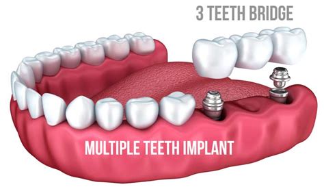 Dental Implants Vs Dentures Costs And Benefits To Know