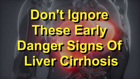 Dont Ignore These Early Danger Signs Of Liver Cirrhosis Youtube