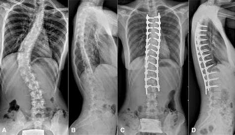 Scoliosis Surgery Rods