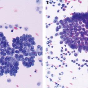 (PDF) Peritoneal washing cytology | Cytopathology