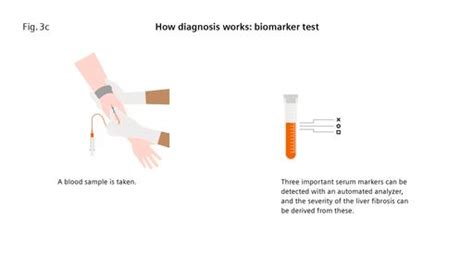 Liver fibrosis: Patients can be at risk of death even without exhibiting symptoms