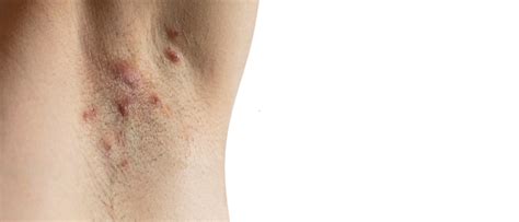 Hidradenitis Suppurativa Acne Inversa Tips Sproet