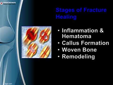 Fracture management -Basic