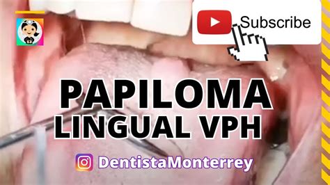 Virus Del Papiloma Huano Vphpapiloma Lingual Causas Youtube