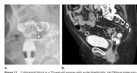 Figure 1 From Imaging And Surgical Management Of Anorectal Vaginal