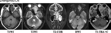 Figure From Imaging Features Of Myoepithelial Carcinoma In The