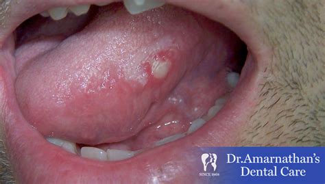 Tongue Ulcer Causes Symptoms And Treatment