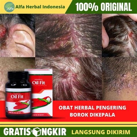 Obat Kepala Borok Borok Dikepala Kepala Berair Bau Kepala