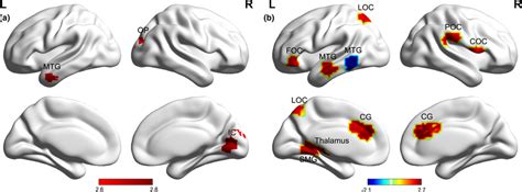 The Distribution Of The Significant Differences In The Local Nodal