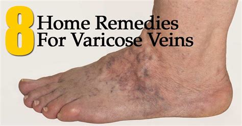 8 Home Remedies For Varicose Veins