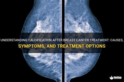 Understanding Calcification After Breast Cancer Treatment Causes Symptoms And Treatment