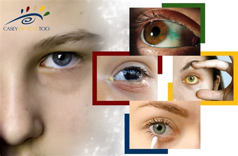 Eye Discharge Causes And Treatment Casey Optical Too Blog