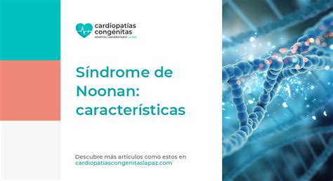 S Ndrome De Noonan Caracter Sticas Cardiopat As Cong Nitas La Paz