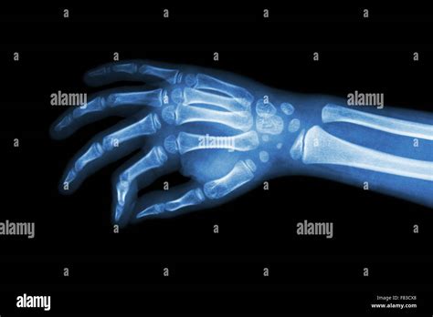 Child Hand X Ray Hi Res Stock Photography And Images Alamy