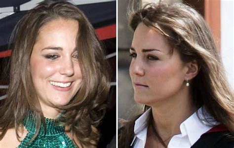 Has Kate Middleton Had A Nose Job