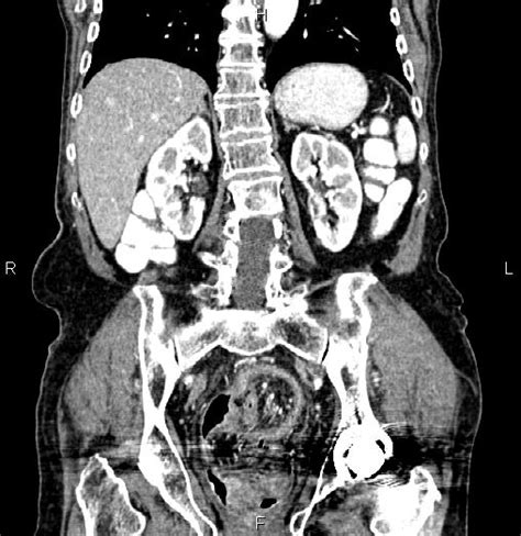 Rectosigmoid Intussusception Due To Tumoral Infiltration Image