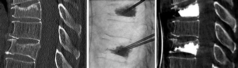 Neuroradiologie Therapie Vertebroplastie Kyphoplastie