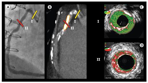 Vulnerable plaque on ¹⁸F NaF PET imaging In A coronary angiography