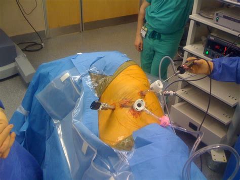 Robotic Segmentectomy Operative Techniques In Thoracic And