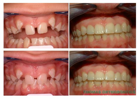 missing-lateral-incisors