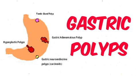 Mistakes In The Management Of Gastric Polyps And How To, 50% OFF