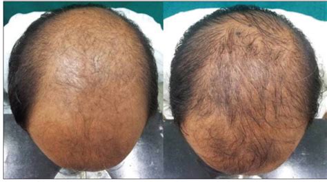 Superiority of dutasteride over finasteride in hair regrowth and ...