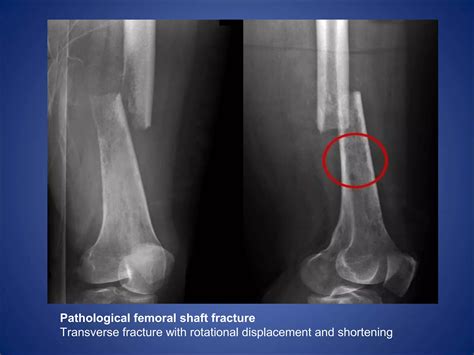 Lower limb fractures | PPT
