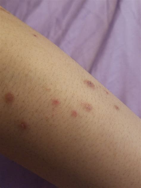 Bug Bites Or Eczema Eczema