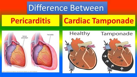 Difference Between Pericarditis And Cardiac Temponade Youtube