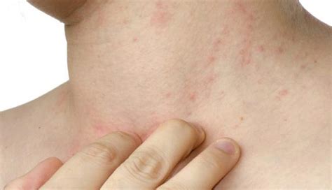 5 Ways To Prevent Your Skin From Fungus Infection - lifeberrys.com