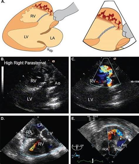 Ventricular Septal Defects Echocardiography In Pediatric And Adult ...