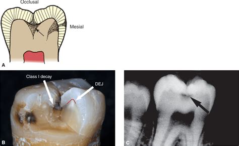 Occlusal Decay