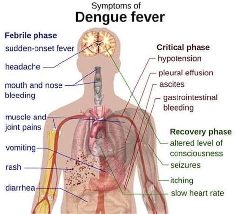 Dengue: Symptoms, Complications, and Treatment