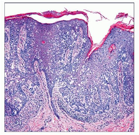 Extramammary Paget Disease Basicmedical Key