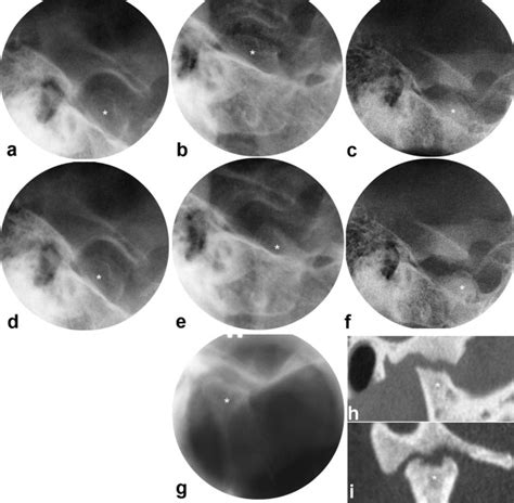 JIA Patient With Consistently Progressing Disease Course In The TMJs