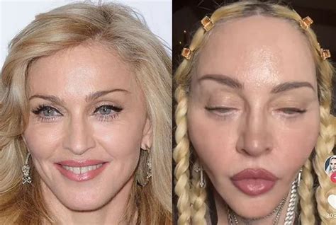 Madonna Chirurgie Esthétique Lifting Du Visage 2024