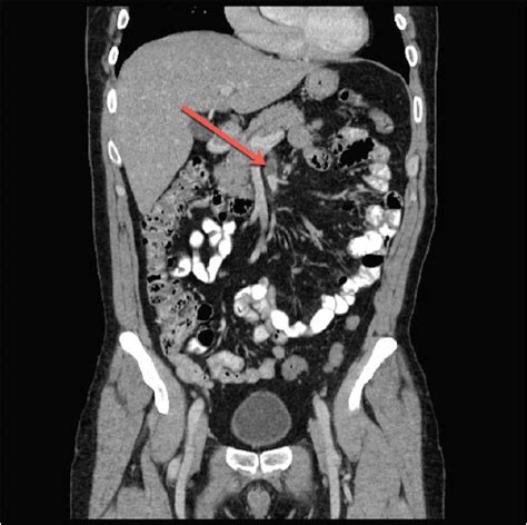 Isolated Dissection Of The Superior Mesenteric Artery The Western