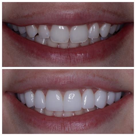 Escoge Bien Tus Carillas Dentales Guia Dental Mexicali