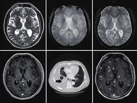 The Axial T2 Weighted Magnetic Resonance Imaging Mri Reveals No