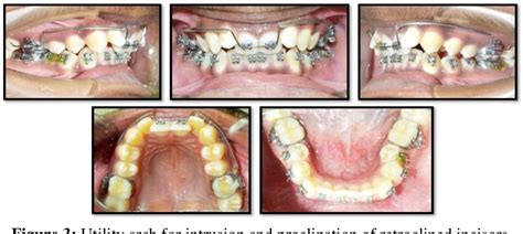 Figure 3 From Class Ii Correction With Forsus Fixed Functional Appliance In Class Ii Division 2